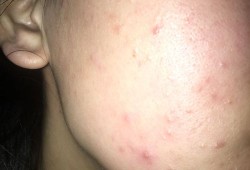 怀孕脸上长痘痘是什么原因,孕期脸上长粉刺是怎么回事