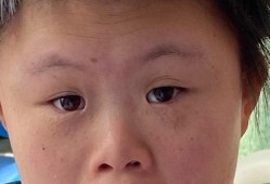 婴儿鼻梁高低怎么看,胎儿鼻梁低平