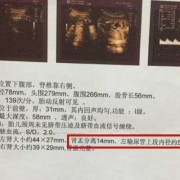 胎儿双侧肾盂无分离是什么意思,胎儿双肾盂分离是什么意思