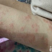 怀孕了长湿疹怎么办,怀孕期间为什么长湿疹呢