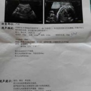 胎儿腹部肠管回声增强必须做羊穿吗,胎儿肠道回声增强怎么回事,其他正常