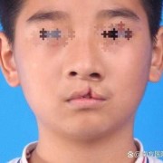 胎儿唇裂（胎儿唇裂是什么原因造成的）