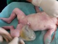 胎儿脐带有囊肿有影响吗,胎儿有囊肿孩子能要吗22周