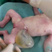 胎儿脐带有囊肿有影响吗,胎儿有囊肿孩子能要吗22周