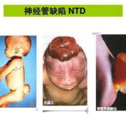 什么是神经管缺陷,胎儿神经管畸形是什么原因引起的