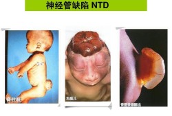 什么是神经管缺陷,胎儿神经管畸形是什么原因引起的