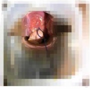 孕期宫颈息肉怎么办,孕期宫颈息肉一直有少量出血怎么办
