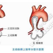 胎儿主动脉狭窄能要吗（什么是主动脉狭窄）