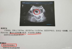 怀孕期间检查（做阴超能检查出什么呢?能不能检查出宫外还是宫内孕的呀）