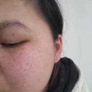 孕期脸上长斑怎么办（孕期长斑怎么回事）