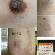 乳头湿疹怎么治疗,孕期乳晕湿疹是什么原因