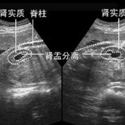 肾盂不分离是什么情况,胎儿肾盂无分离是男孩还是女孩