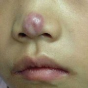 孕期鼻子变红（孕期鼻子变红生男生女）
