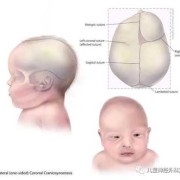 额缝是哪里,胎儿额缝早闭和基因有关系吗