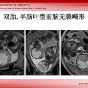 胎儿核（胎儿核磁共振对宝宝有影响吗）