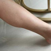 腿上有袜子勒出的印是什么回事,孕妇肚子勒印影响胎儿吗