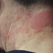 孕期脸上发红（孕妇脖子痒痒一抓发红起一块红疙瘩是为什么？能擦什么药）