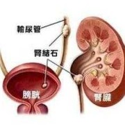孕期肾结石症状（孕期肾结石症状表现）