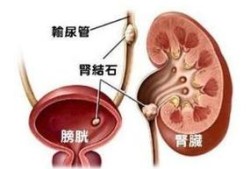 孕期肾结石症状（孕期肾结石症状表现）