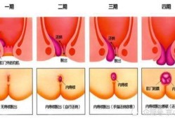孕妇得痔疮了怎么办,内痔和外痔的区别图片
