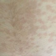 孕期肚皮过敏（孕妇肚子上长了红点点，很痒，怎么办）