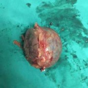 胎儿腹腔囊肿手术费用多少,胎儿腹腔囊肿怎么回事啊