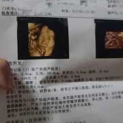 彩超对胎儿有没有影响（彩超到底有没有辐射）