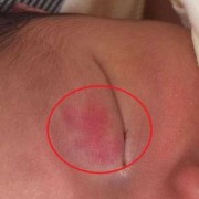 孕妇怎样防止孩子有胎记,怎么预防胎儿长胎记的方法