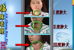 甲亢会遗传给宝宝吗,胎儿遗传谁的基因更多