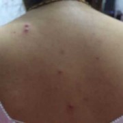 孕期一直长痘痘怎么办（怀孕后背上长了好多痘痘怎么办）
