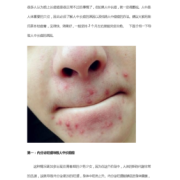 孕期人中长痘的原因（孕期人中长痘痘什么原因）