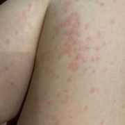 孕期腿过敏（孕期腿过敏怎么办）