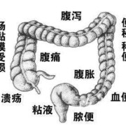 慢性肠炎能自愈吗，导致慢性肠炎的原因是,孕期慢性肠炎怎么办