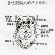 孕期腹膜炎（孕期腹膜炎）