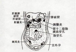 孕期腹膜炎（孕期腹膜炎）