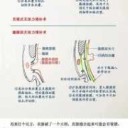 小孩疝气怎么治,胎儿肠疝是什么意思