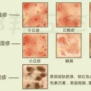 孕期外阴湿疹怎么办（阴部湿疹要如何治疗）
