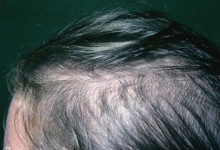 孕期不长头发（头发好象没有发根是为什么）
