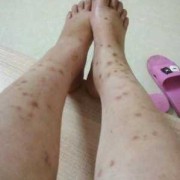孕妇为什么会得湿疹,孕期湿疹止痒最有效的方法