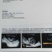12周胎儿鼻骨显示不清（怀孕产检，nt检查结果看不到鼻骨咋办，胎儿会不会有问题呢）