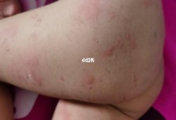 孕早期得了荨麻疹怎么办,孕期荨麻疹对胎儿有没有影响