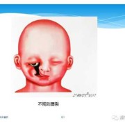 胎儿唇腭裂的原因（胎儿唇腭裂的原因跟男方有关吗）