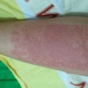 孕期腿过敏（孕期腿过敏怎么办）
