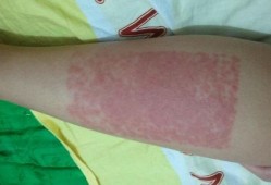 孕期腿过敏（孕期腿过敏怎么办）