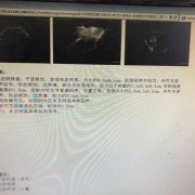 怀孕了，但查出有子宫肌瘤要紧吗,怀孕期间子宫肌瘤怎么办?