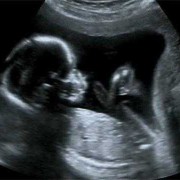 孕晚期宝宝还会发生畸形吗,胎儿畸形包括哪些部分