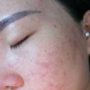 孕期脸上长痘痘怎么办（孕妇脸上长痘痘怎么快速去除）