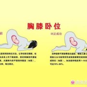 胎儿臂位（胎儿臂位）