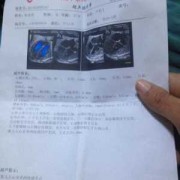 如何让胎儿强光点消失（孕期唐筛低风险左心室有强光点怎么办）