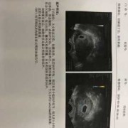 没胎心怎么办,胎儿没有胎心的表现有哪些